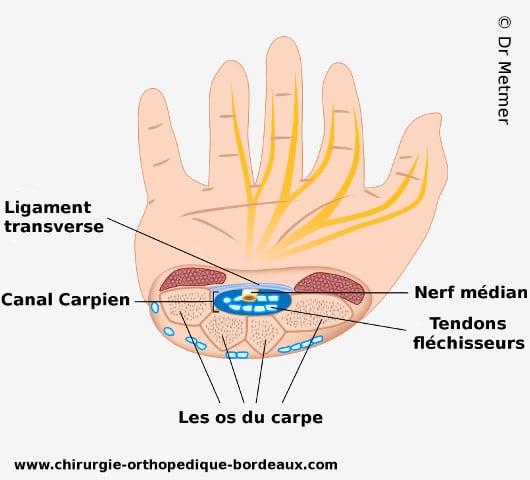 Opération canal carpien, Endoscopie, Chirurgien, le carnet de calli, Syndrome du canal carpien