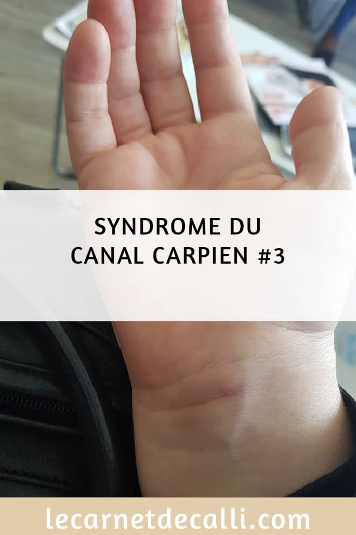 syndrome du canal carpien3